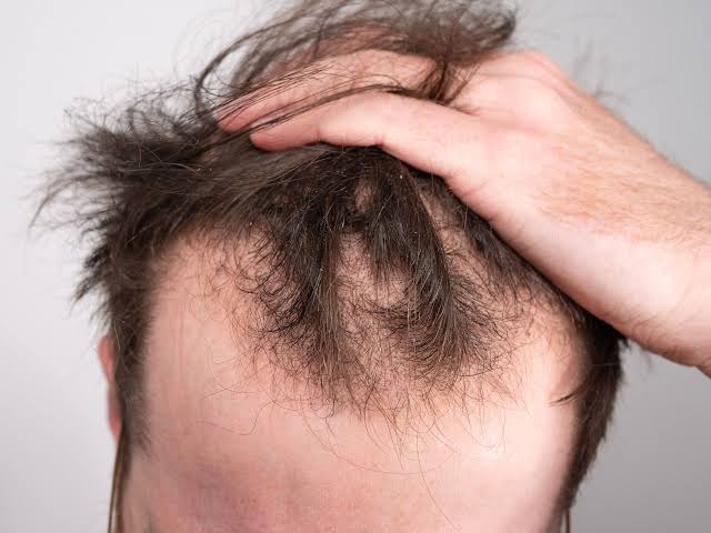 causes of Hair loss 