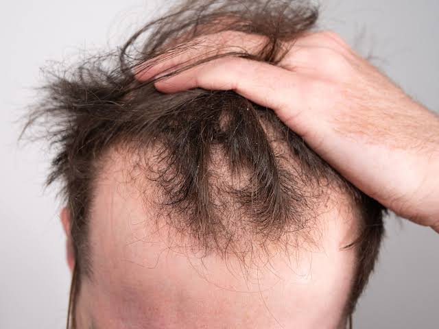 इस Hair loss treatment से 15 दिन में ही मिल जाएंगे "लंबे बाल जिन्हें संभाल नहीं पाएंगे आप" 4 causes of Hair loss