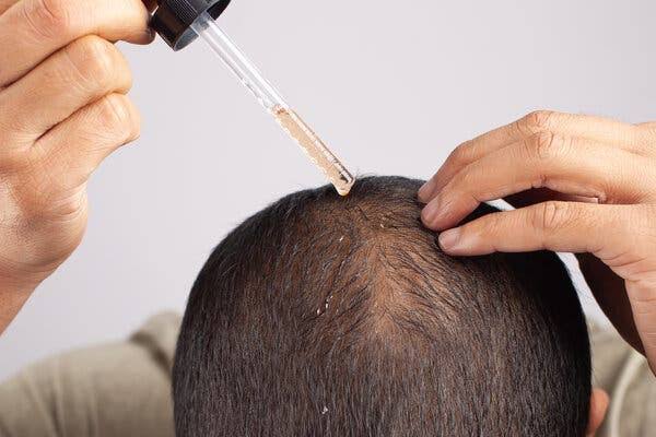 इस Hair loss treatment से 15 दिन में ही मिल जाएंगे "लंबे बाल जिन्हें संभाल नहीं पाएंगे आप" 5 Hair loss remedy