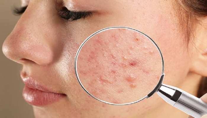 Pimples से छुटकारा पाने के लिए हफ्ते में बस 3 बार लगाइए यह फेसपैक 2 Pimples problem