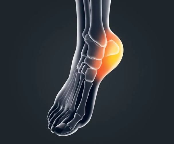 Heel pain से राहत पाने के लिए अरंडी के पत्तों का तेल बनाकर ऐसे लगाएं 5 Home remedy for Heel pain relief